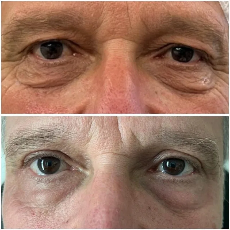 Dr Jérôme Quezel Guerraz - Médecine esthétique - Profiloplastie - Blépharoplastie - Peeling Phénol - Endolift